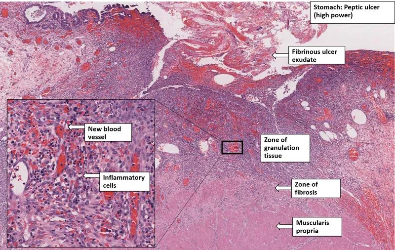 Peptic Ulcer Histology: Inflammation, Granulation, Fibrosis