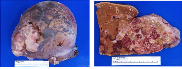 Liver abscess with fibrous capsule and necrotic center