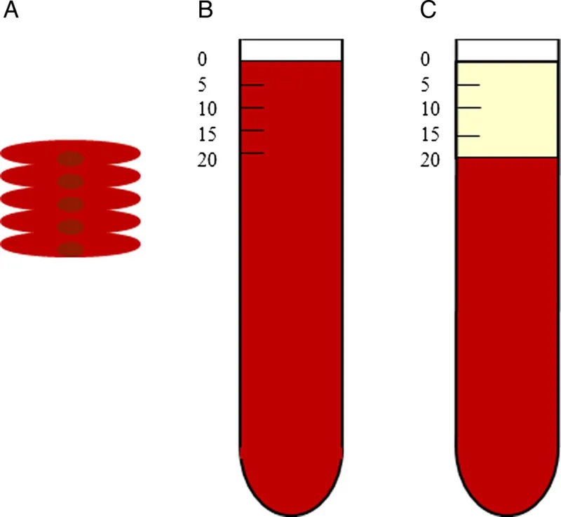 Rouleaux formation and ESR in inflammation