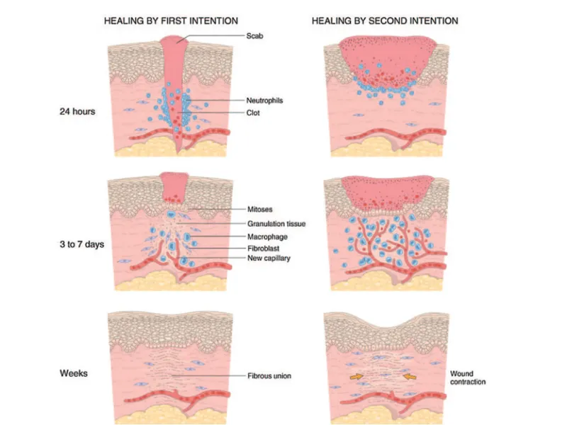 Primary vs. Secondary Intention Wound Healing