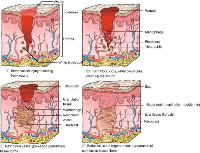 Wound healing process: inflammation, granulation, scar