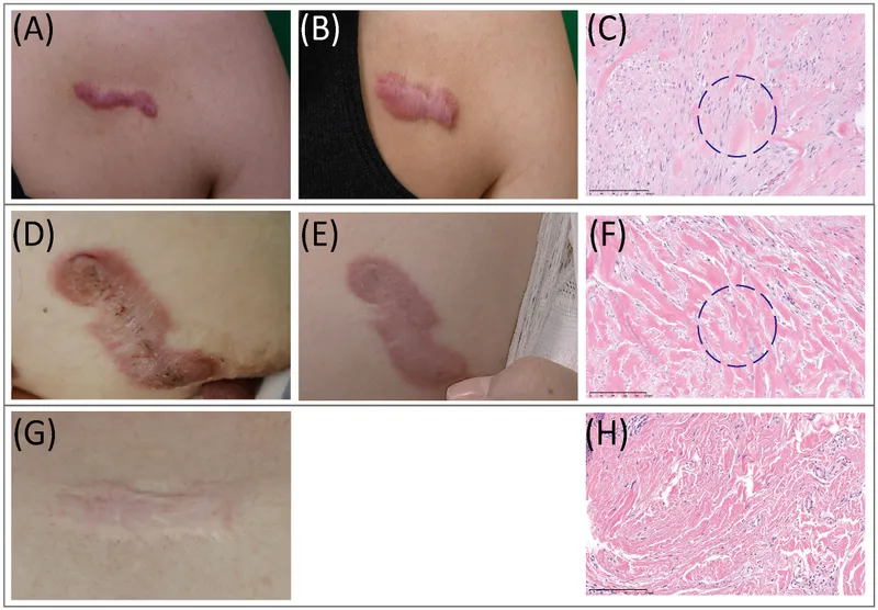 Keloid Histology and Appearance