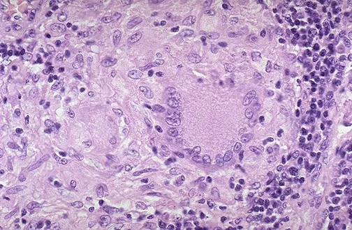Langhans giant cell in granulomatous inflammation