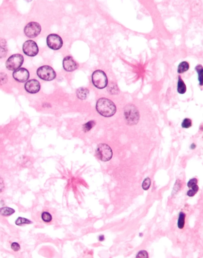 Asteroid bodies in sarcoidosis histology
