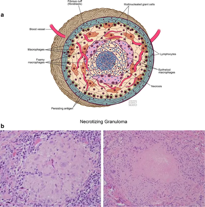 Necrotizing Granuloma Diagram and Microscopic Views