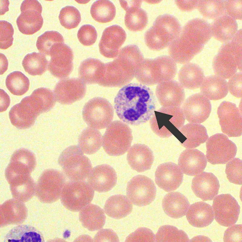 Toxic neutrophil with Döhle body