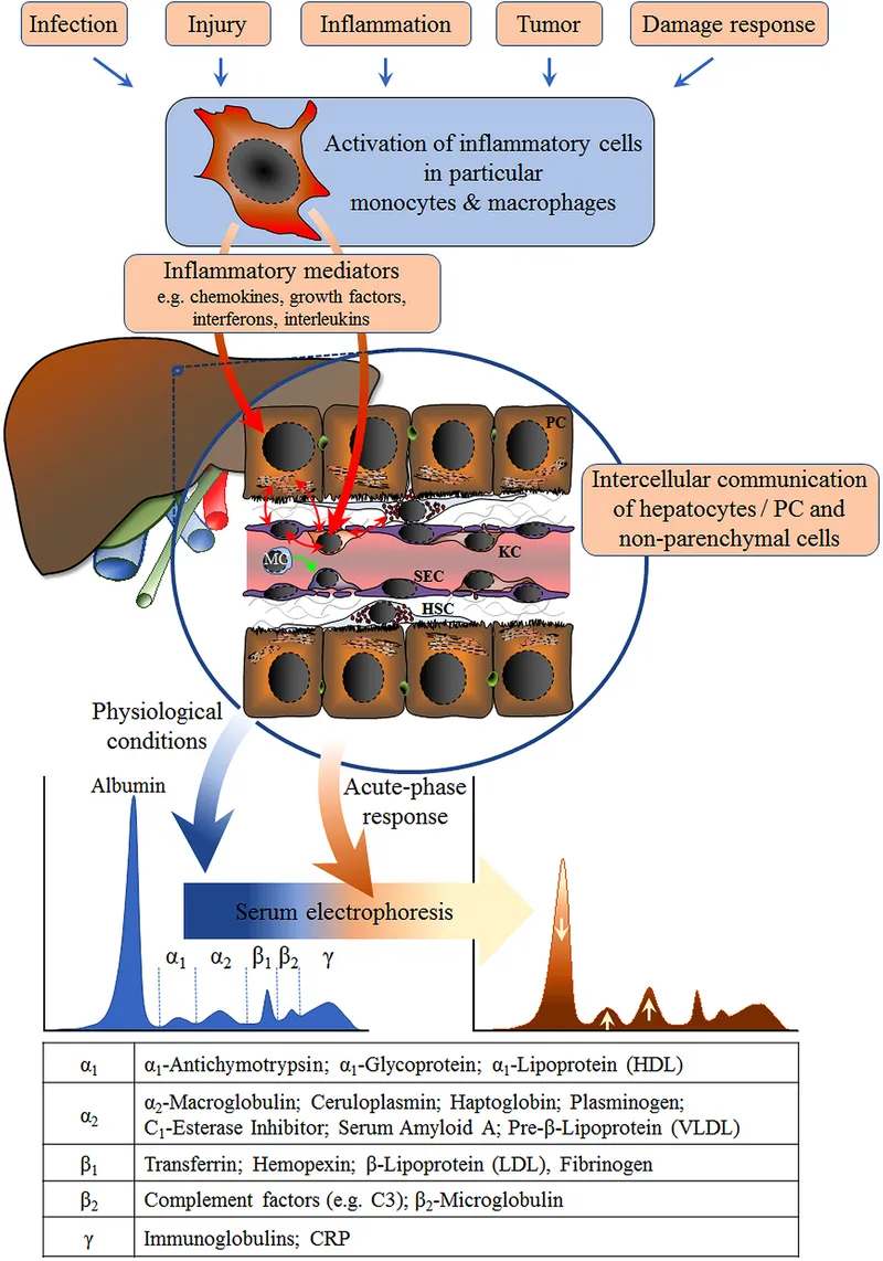 Acute-phase response and serum electrophoresis