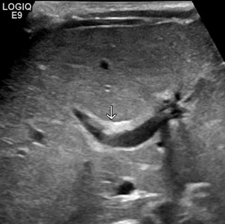 Ultrasound: Triangular cord sign in biliary atresia