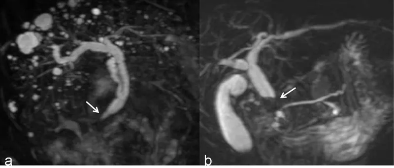 MRCP: Choledocholithiasis and biliary stricture