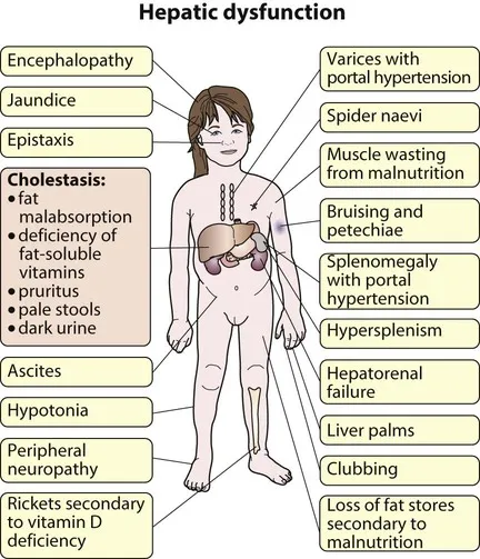 Clinical manifestations of hepatic dysfunction