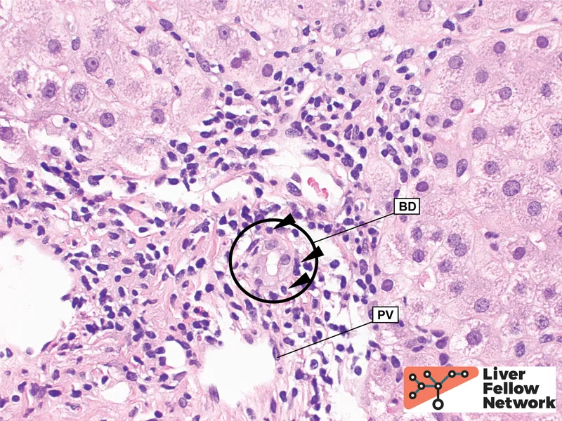 Acute cellular rejection in liver transplant