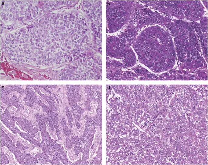 Histology of hepatoblastoma