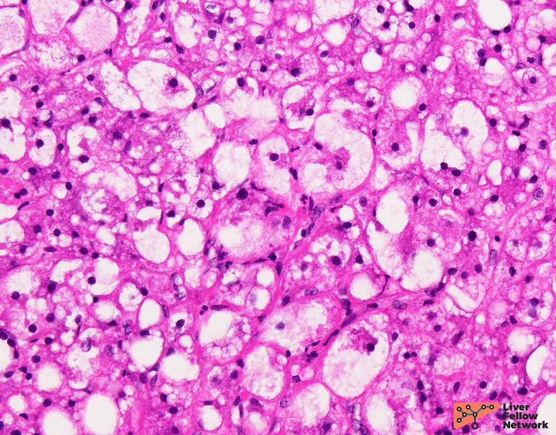 Histopathology of NASH with ballooning degeneration
