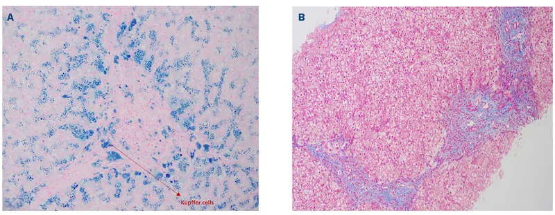 Perls' Prussian blue stain liver biopsy hemochromatosis