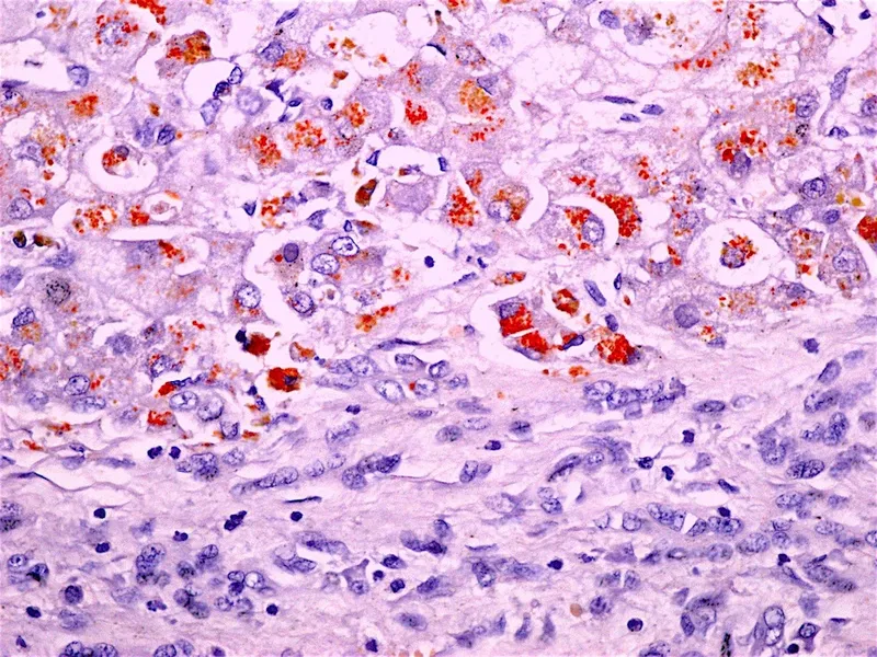 Wilson's Disease: Liver Copper Staining