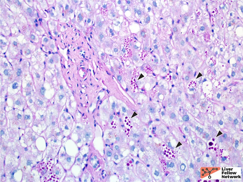 Alpha-1 Antitrypsin Deficiency: PAS-D Positive Globules