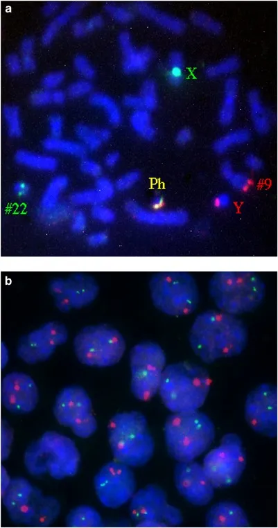 FISH showing BCR-ABL translocation (Philadelphia chromosome)
