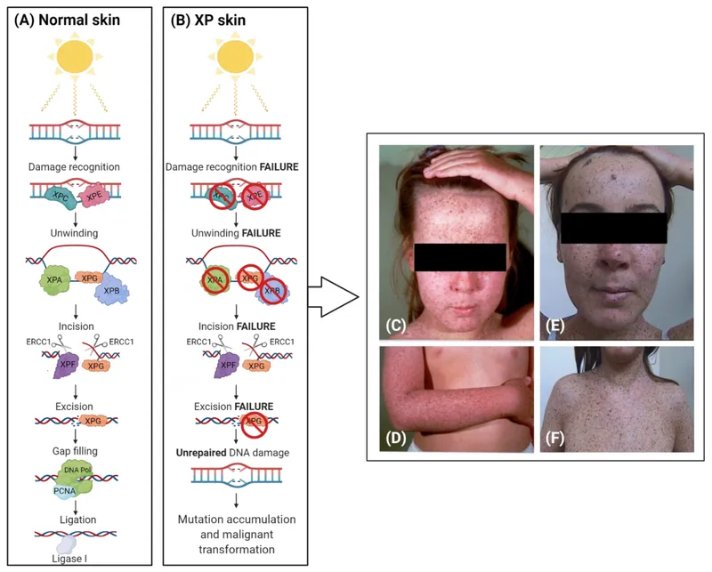 Xeroderma Pigmentosum: DNA Repair Defect and Clinical Signs