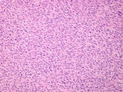 Leiomyoma: Spindle cells, no atypia, low mitosis