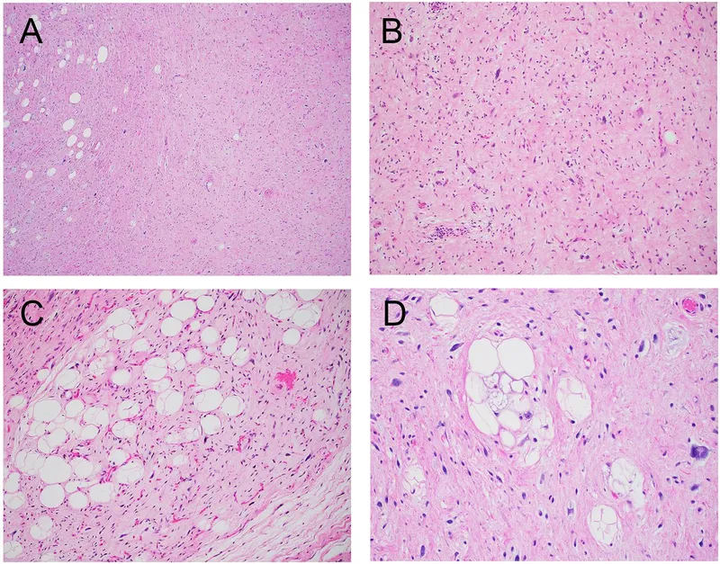 Lipoma vs Liposarcoma Histology