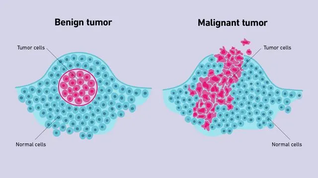 Benign vs. Malignant Tumor Cell Growth