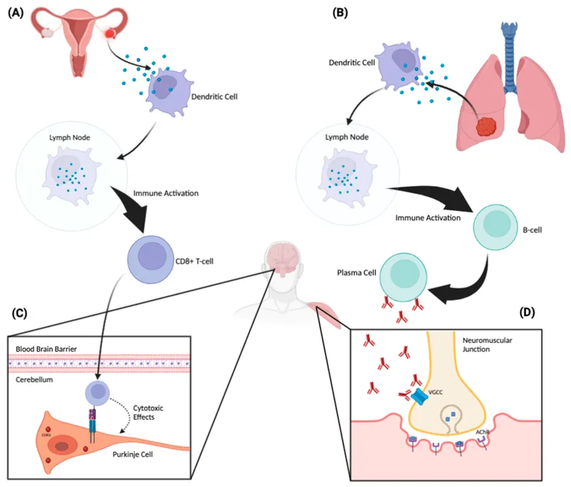 Paraneoplastic Neurologic Syndromes: Immune Mechanisms
