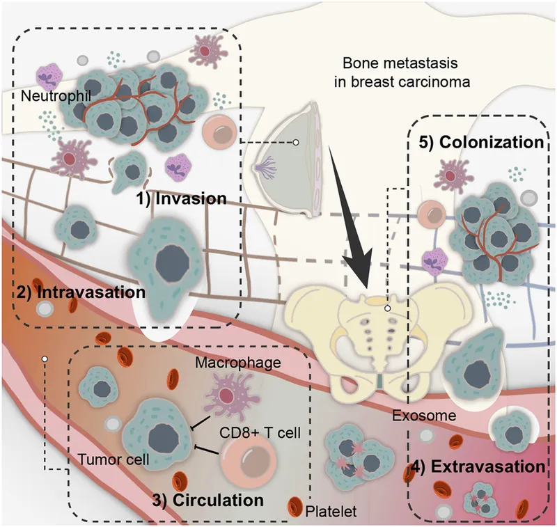 Bone Metastasis in Breast Carcinoma Diagram
