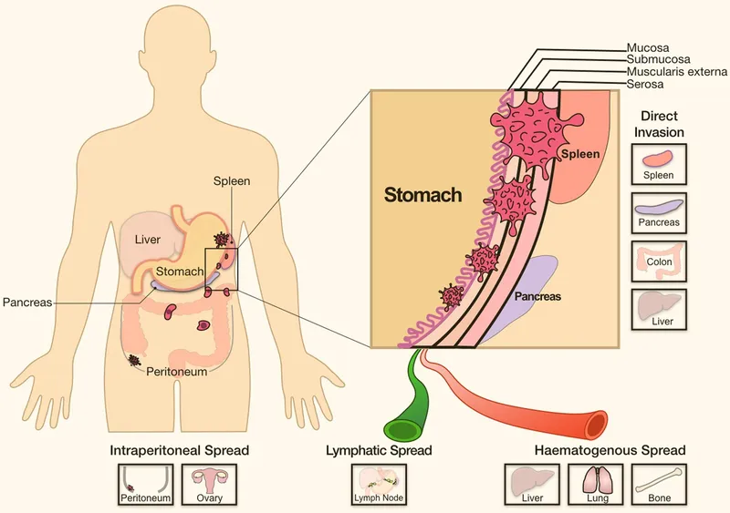 Tumor invasion and metastasis pathways from stomach cancer