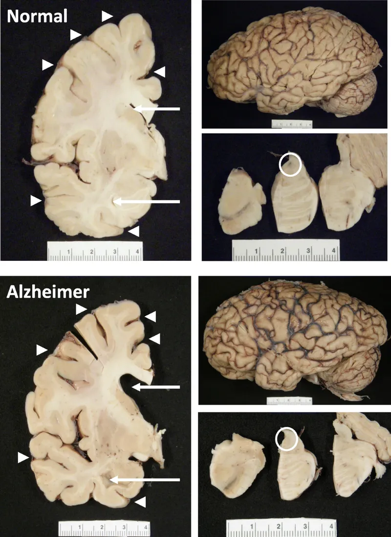 Normal vs. Alzheimer's Brain: Gross and Sectional Views