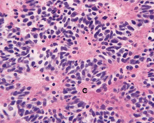 Medulloblastoma with Homer Wright rosettes