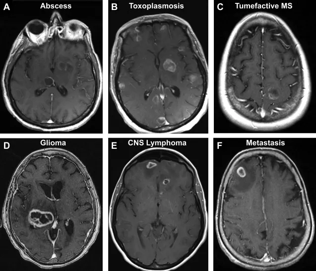MRI Brain: Ring-enhancing lesions in CNS infections