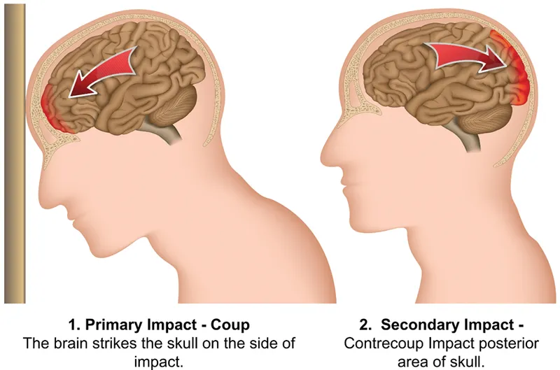 Coup and Contrecoup Brain Injury Illustration