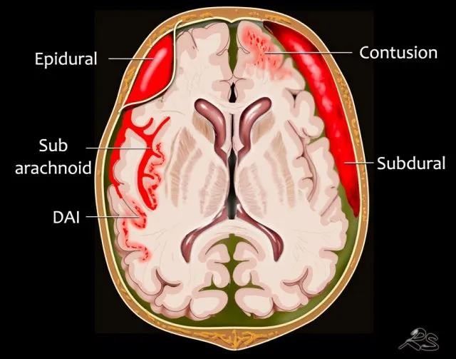 CNS Trauma: Hemorrhages, Contusion, DAI