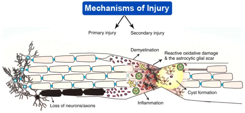 Spinal Cord Injury: Primary and Secondary Mechanisms