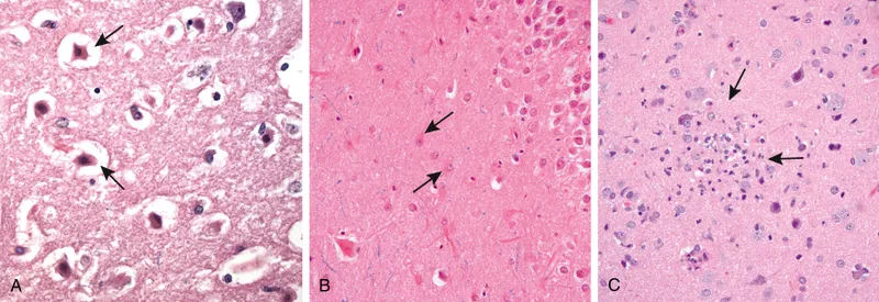 Red neurons in acute hypoxic ischemic injury