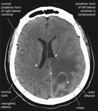 CT showing cerebral edema, sulcal effacement, mass