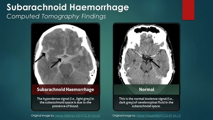 CT scan: subarachnoid hemorrhage vs. normal