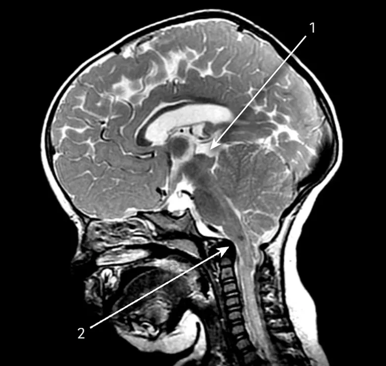 Chiari II malformation with myelomeningocele on T1 MRI