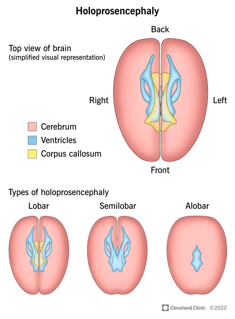 Types of Holoprosencephaly: Lobar, Semilobar, and Alobar