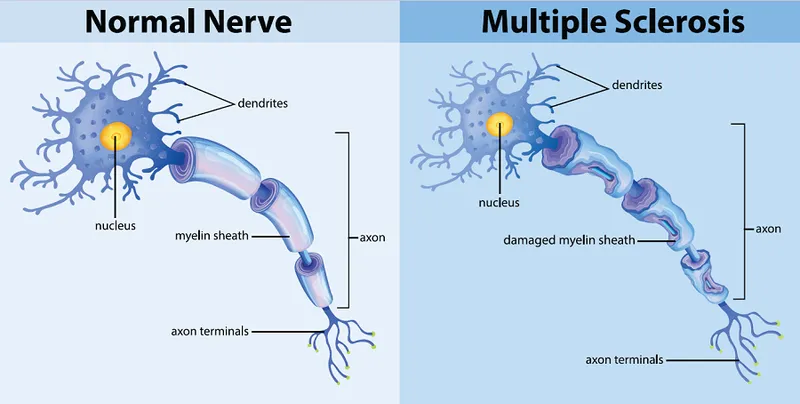 Normal vs. MS Nerve: Myelin Sheath Damage