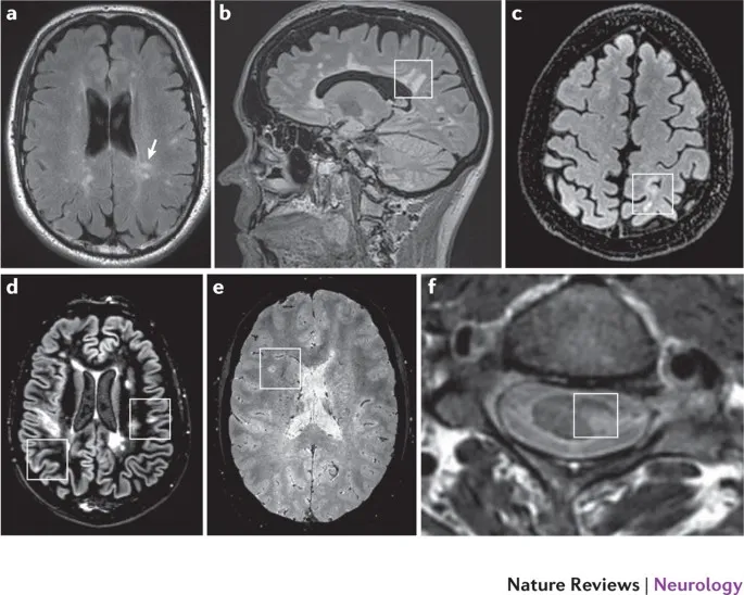 MRI features of MS and NMOSD lesions