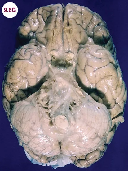 TB meningitis basal exudates gross pathology