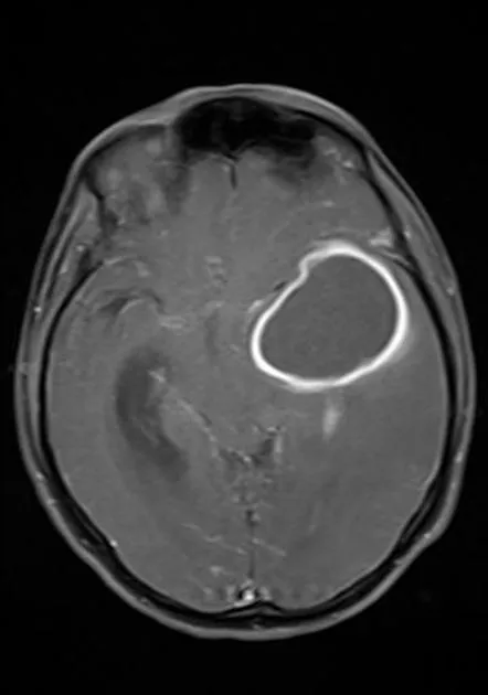 MRI showing ring-enhancing brain abscess