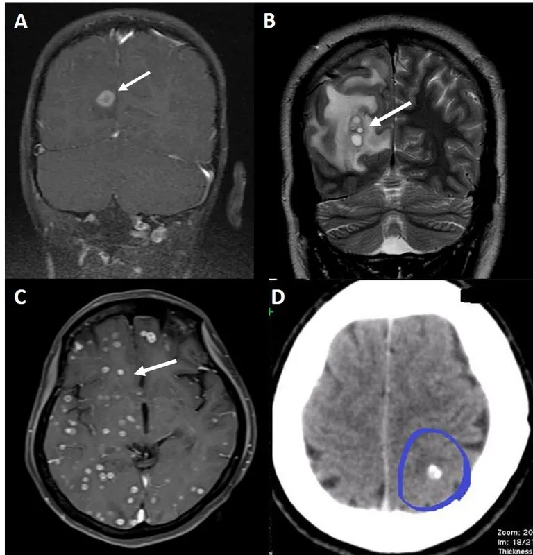 Neurocysticercosis lesions on MRI and CT