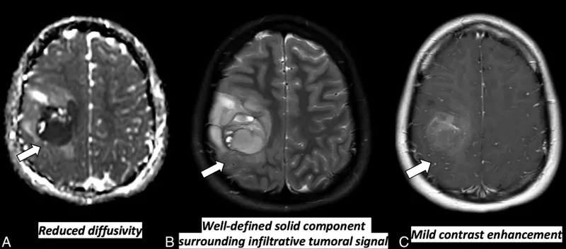 Brain MRI: Metastatic CNS tumor with necrosis and edema