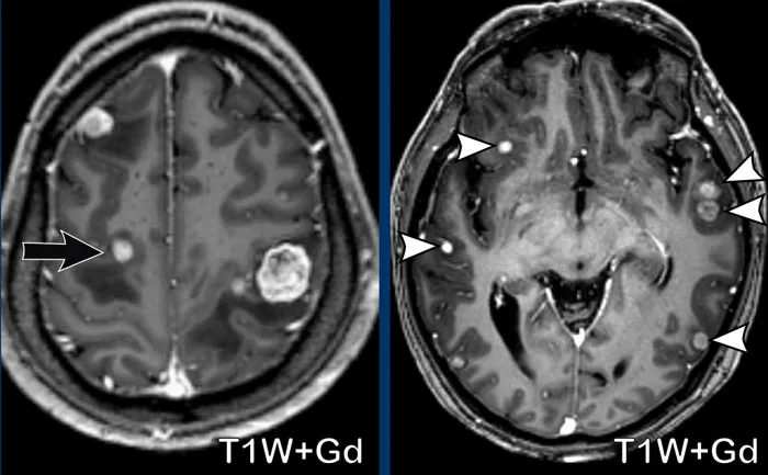 MRI: Multiple ring-enhancing metastatic brain lesions