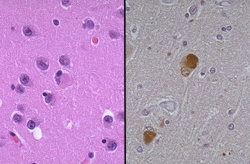 Lewy bodies in neurons, H&E and alpha-synuclein stain