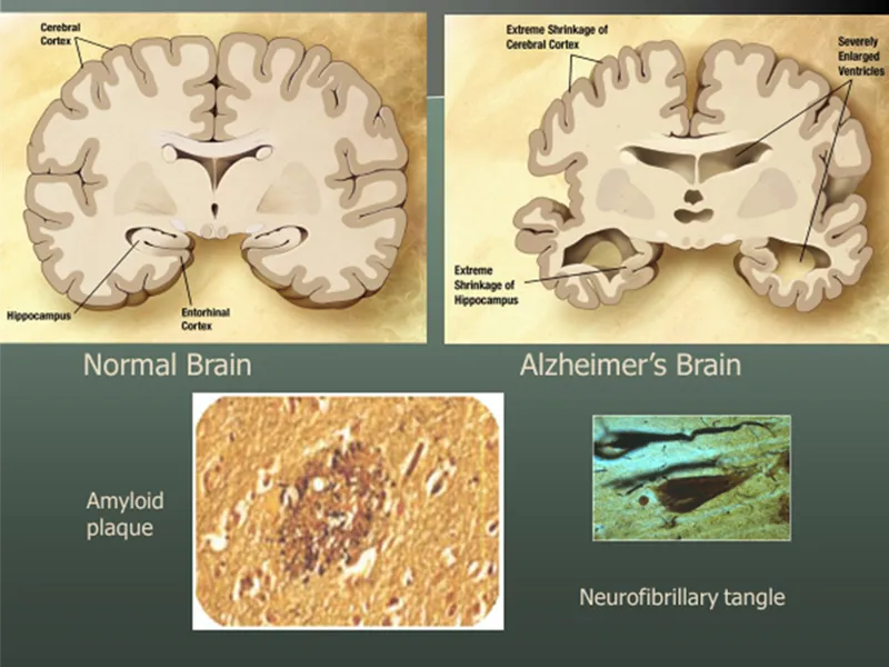 Alzheimer's Brain Changes: Gross and Microscopic
