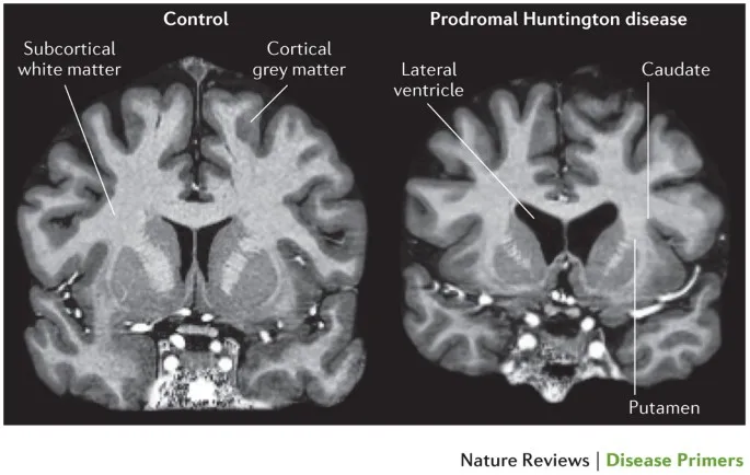 MRI showing caudate atrophy in prodromal Huntington's