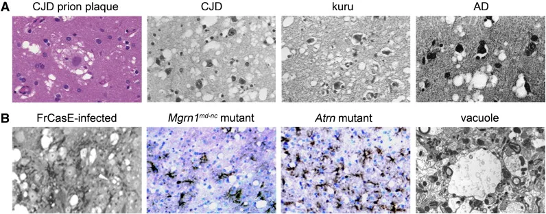 Histology of Spongiform Encephalopathy in Prion Diseases